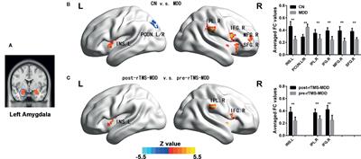 Repetitive Transcranial Magnetic Stimulation Improves Amygdale Functional Connectivity in Major Depressive Disorder